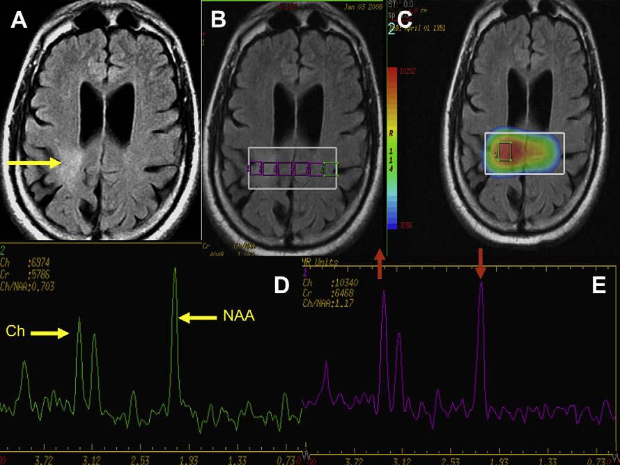 Author's personal copy Neuroimaging in Neuro-Oncology 189 pmrs in neuro-oncology may be used preoperatively in differentiating between neoplastic and nonneoplastic disease and grading and expanding