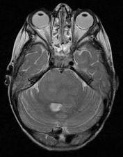 Posterior thalamus (30%) Enhancement: Variable and may not be present Calcification: Less than 4% Differential diagnosis a.