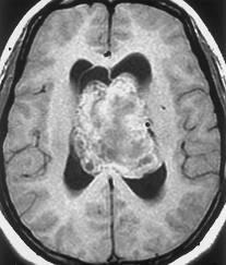 CENTRAL NEUROCYTOMA Terminology Intraventricular neuroepithelial tumor with neuronal differentiation Imaging Findings Best diagnostic clue: Bubbly mass in frontal horn or body of lateral ventricle