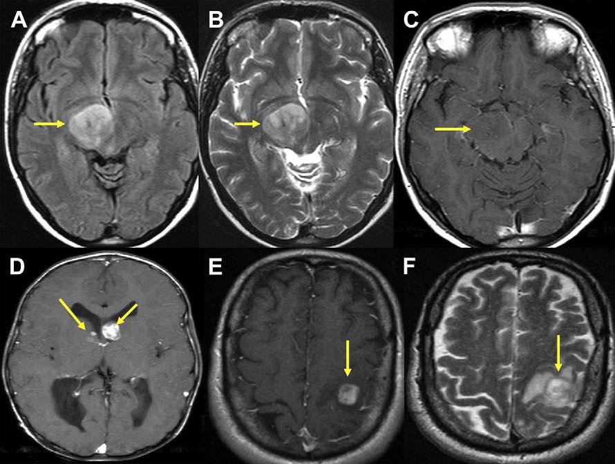 Author's personal copy Neuroimaging in Neuro-Oncology 177 Fig. 2. Circumscribed astrocytomas.