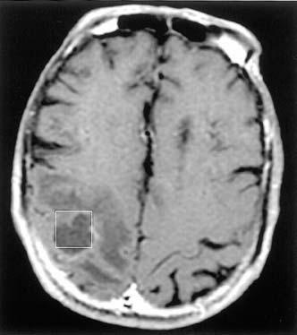 109 A B C D Ac Suc Lac AA Ala 4 3 2 1 0 Chemical shift (ppm) Figure 1. A 58-year-old man with surgically proven pyogenic brain abscess in the right parietal lobe.