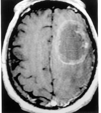 110 A B C D Lac 4 3 2 1 0 Chemical shift (ppm) Figure 2. A 65-year-old man with a pathologically proven left frontoparietal lobe metastasis from primary lung adenocarcinoma.