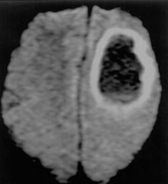 The 2 2 2-cm voxel (box) in the center of the lesion represents the 1H-MRS volume of interest.