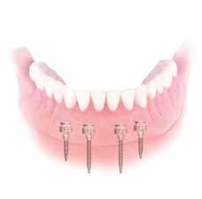 a Patient s guide Mini-DentalImplant When can they be used DENTURE When critically needed for support purposes, and where solid bony adaptation (integration) has clearly occured, mini implants can