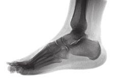 constraints, and elderly patients with many medical conditions. Patients with arthritis, diabetes, and circulatory foot problems may all be helped by non-surgical treatments.
