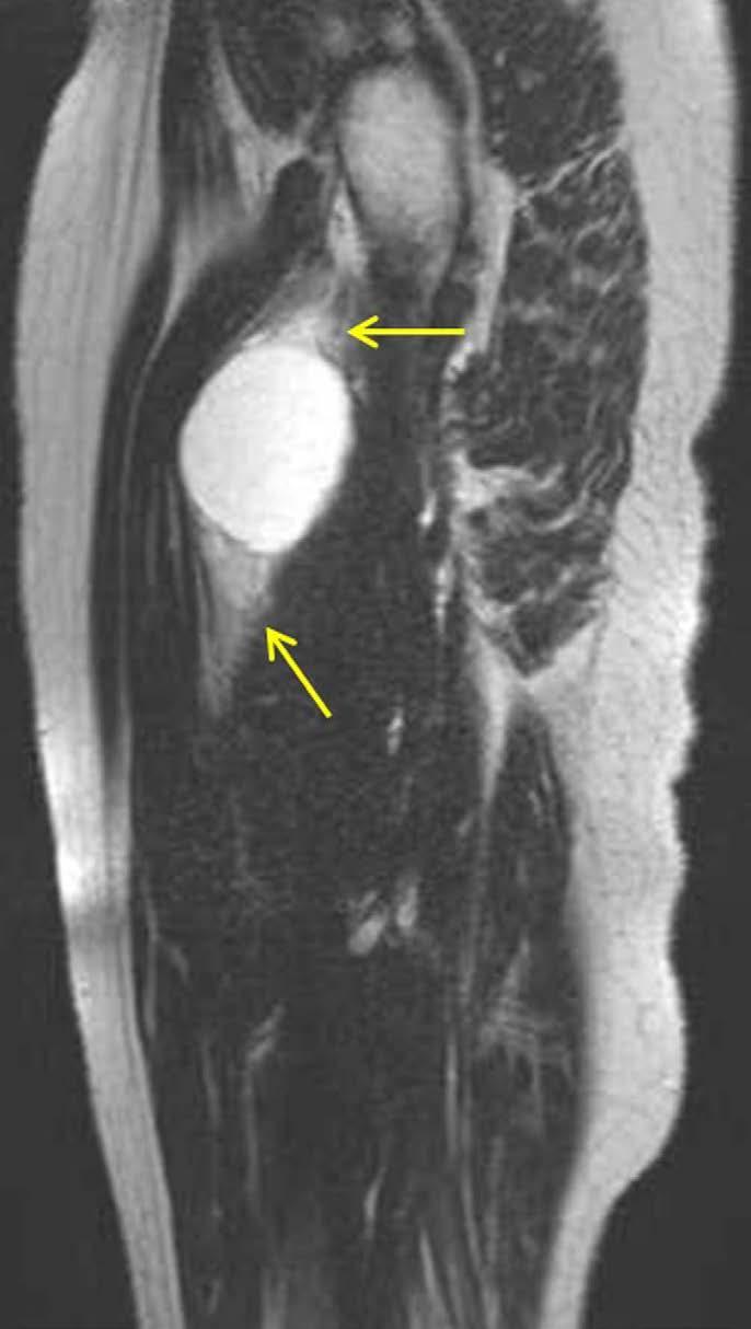 A target sign was deemed to be present when the tumor showed central low SI and peripheral high SI on T2WI (19). The fat split sign was defined as a rim of fat surrounding the tumor (20).