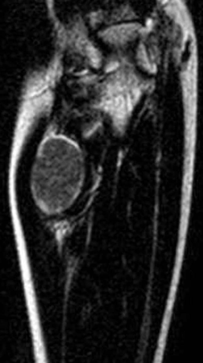 MRI Findings to Distinguish Benign Peripheral Nerve Sheath Tumors and Myxoid Tumors Eunchae Lee, et al.
