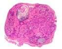 Myoepithelial Tumors of ST/Bone