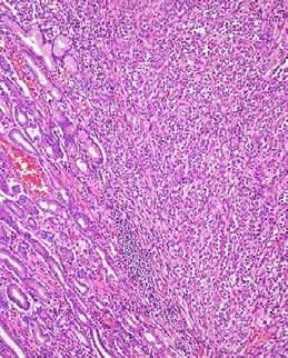 CCS-like Tumor of GI Tract CCS-like Tumor of GI Tract GI tract Soft tissue S100 pr 100% 100% HMB45 Uniform clear 0