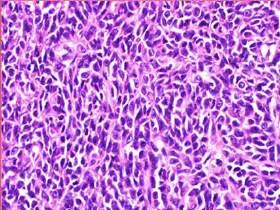 Tumors with EWSR1-ATF1 or EWSR1-CREB1 fusions Angiomatoid fibrous histiocytoma Clear cell sarcoma of soft tissue