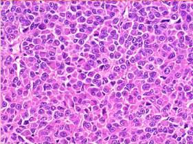 Angiosarcoma of salivary gland Hyalinizing clear cell salivary carcinoma Clear cell odontogenic carcinoma Thway