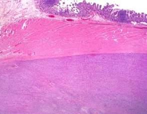 Endometrial Stromal Sarcoma Case 19 Seminoma