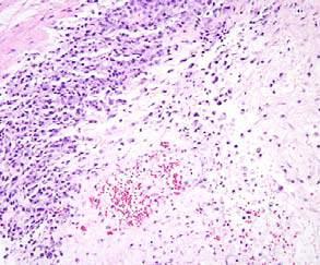 glands, GIST ASPSCR1-TFE3 alveolar soft part sa, juvenile renal cell carcinoma TMP3-ALK inflammatory myofibroblastic tumor, anaplastic large cell lymphoma YWHAE-NUTM22A/B endometrial
