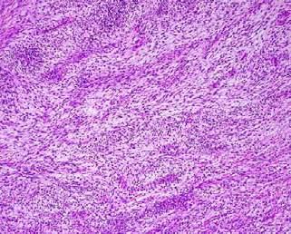 Nerve Sheath Tumor SS18