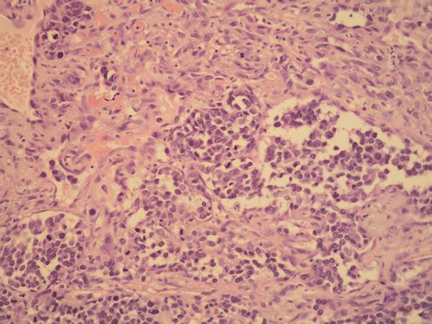 The tumor infiltrated the bone (asterisk) ((c) HE, 100). Tumor cells showing immunohistochemical expression of CD31 ((d) 200).