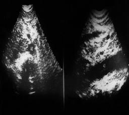 Involvement of the gastrohepatic and gastrocolic ligament seen at operation in one patient was not seen preoperatively on sonography.
