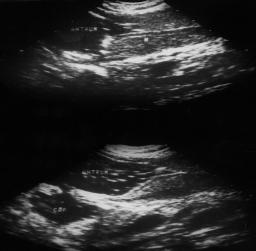 of the mass. Figure 6a. Sonogram of the fluid filled stomach showing an intraluminal mass with disruption of wall layering - carcinoma antrum. Figure 6b.