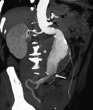Figure 1. Reformatted CT angiography image. Large abdominal aortic aneurysm with significant neck angulation and mural thrombus (asterisk). Additionally, left common iliac artery is occluded (arrow).