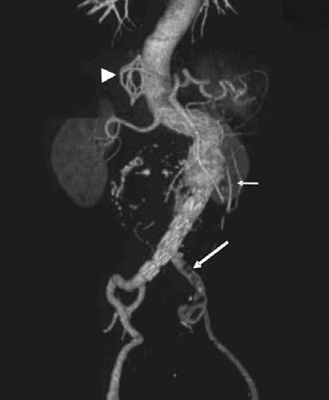 3D reconstruction image showing type 1 endoleak (small arrow) and partially recanalized left common iliac artery (big arrow) as well as the inferior vena cava filter (arrowhead). Figure 3.