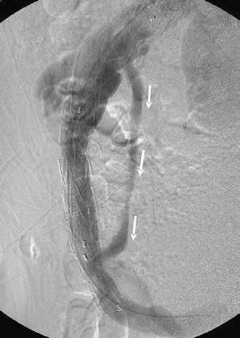 ren, New Jersey, USA) was placed in the suprarenal inferior vena cava at the level of hepatic veins via the same venous access.