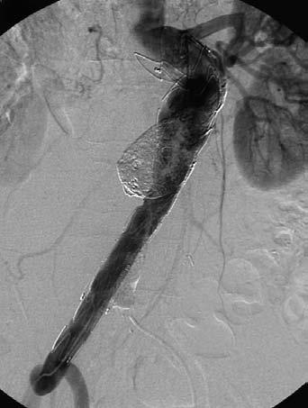After visualizing the exact course of the proximal type 1 endoleak through the partially recanalized, a 4F catheter was advanced into the caudal portion of the sac, followed by placement of a coaxial