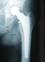 Radiographic cases References: ase study Pre-op Revision of a loose cemented femoral stem (Paprosky Type 3A) was performed in 1992.