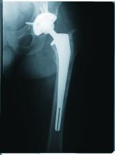 Kadoya Y, Kobayashi, Ohashi H Wear and Osteolysis in Total Joint Replacements Acta Orthop Scand (Suppl 278) 1998; 69 ase study Pre-op Revision of a loose cemented femoral stem (Paprosky Type 2) was