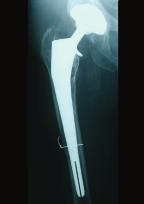 Hydroxyapatite oated Hip and Knee Arthroplasty, ahiers d'enseignements de la SOFOT n 51