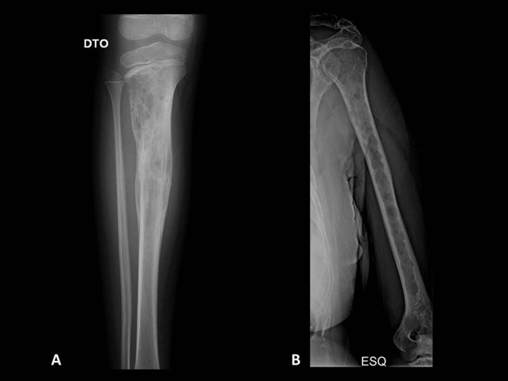 Fig. 11: A - Moth-eaten (type II) and Permeative (type III) lesion. Radiography shows multiple destructive foci of a bone lesion with poorly-defined borders and wide zone of transition.