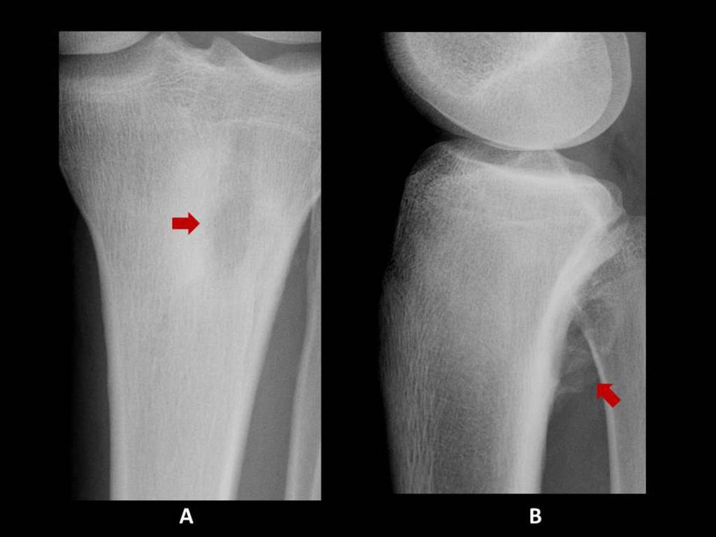 Fig. 20: Osteoblastoma.