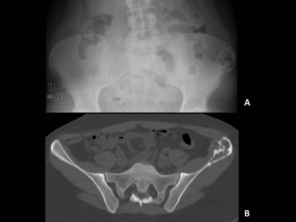 Fig. 33: Conventional chondrosarcoma.