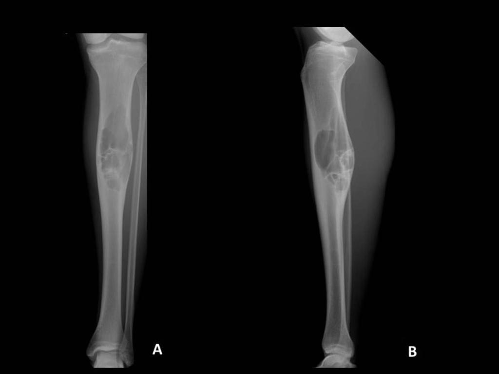 Fig. 37: Aneurysmal bone cyst.