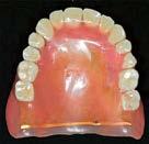 QUARTZ SPLINT MESH QUARTZ SPLINT MESH has been especially designed for reinforcing acrylic resin dentures.