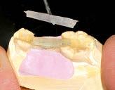 A flat or round shape can be done. QUARTZ SPLINT UD is pre-impregnated with a proprietary resin matrix which chemically bonds to composite.