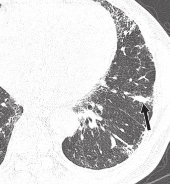 2 74-year-old man with rheumatoid arthritis and surgically confirmed usual interstitial pneumonia.