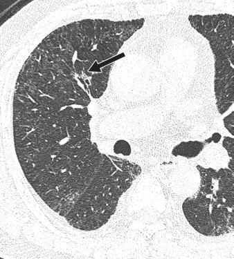 CT of Lung Cancer be watched with caution, even if the shape is not necessarily tumorlike.