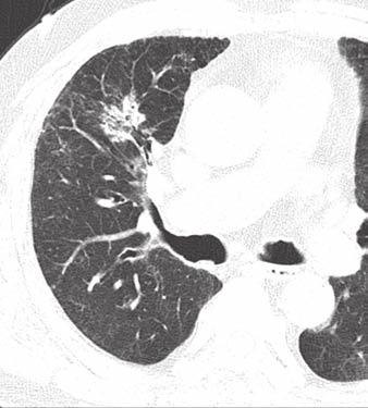 We suppose that lung cancer is unlikely to develop in the cyst wall without adjacent lung tissue, and careful observation of the tumor and surrounding lung condition can add important information to