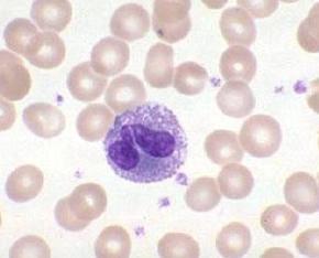Airway Inflammation For patients not responding to standard treatment Sputum eosinophil count Bl