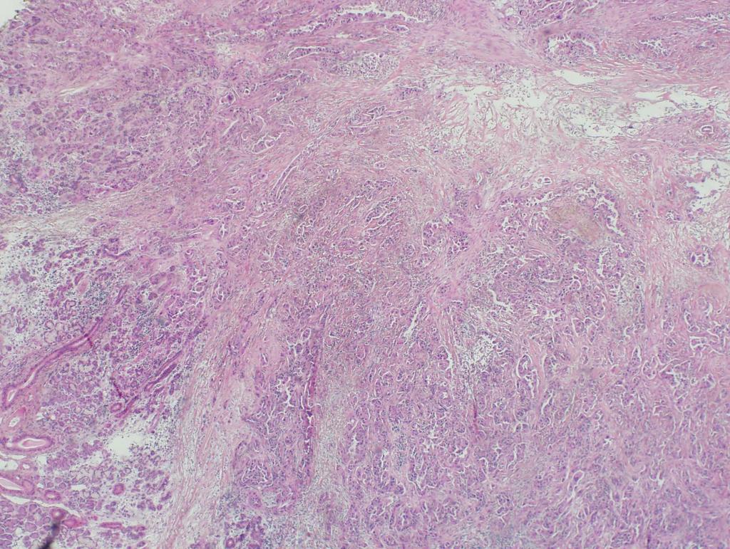 55 year old female with parotid mass