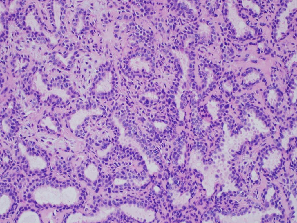 PA with Many Faces: Epithelial
