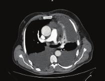 2 Case Reports in Pulmonology (a) (b) (c) (d) Figure 1: (a) A bilateral pleural effusion is noted in the CT obtained during first presentation.