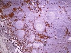 (b) Cytoplasmic staining in tumor cells with immunohistochemical Pan-CK stain. Pan-CK 100. (c) Cytoplasmic and nuclear staining in tumor cells with immunohistochemical Calretinin stain.