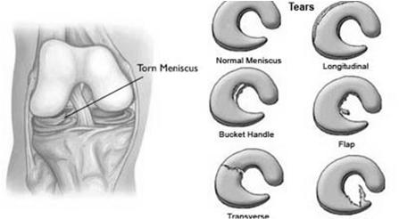 Meniscal Injuries (cont d) 2 wedge-shaped pieces of cartilage act as shock absorbers between femur and tibia; they are tough and