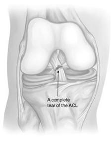 Causes of ACL Injury The anterior cruciate ligament can be injured in several ways: Changing direction rapidly Stopping suddenly Slowing down while