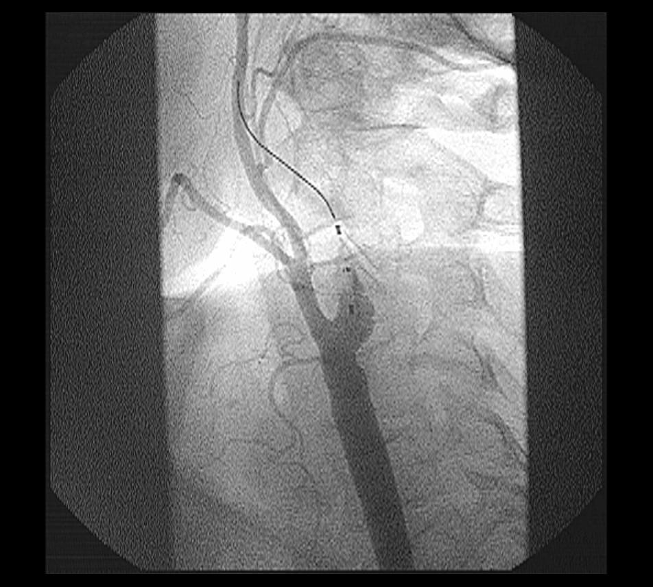 Carotid Filter Issues What to do when filter doesn t Advance?