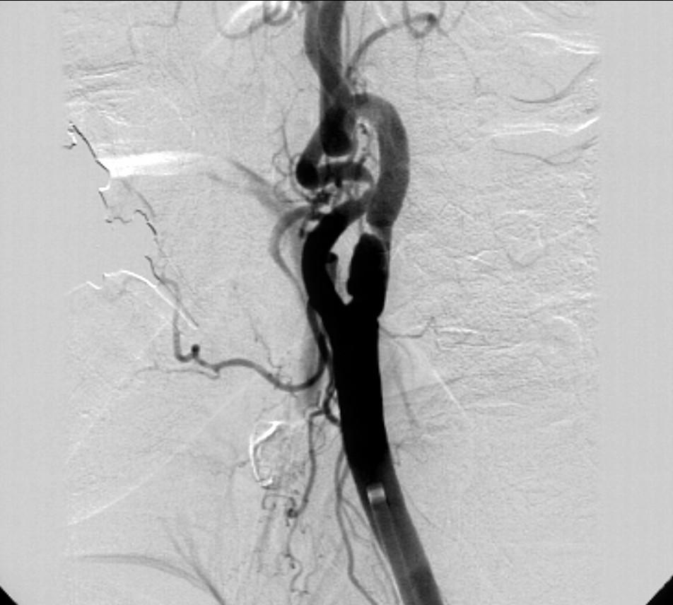 Lessons Learned/Avoid These S STEEP Arch (Type III) SEVERE tortuosity SHARP