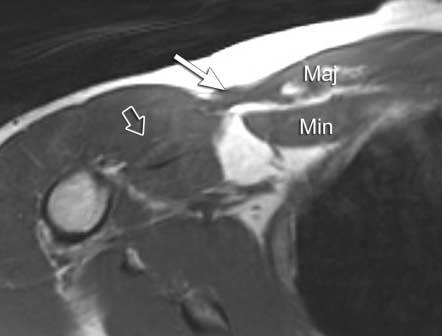 visualization of distal the tendon (open arrows). Note the pectoralis minor muscle (Min) and rib (R). A B C the pectoralis major muscle.