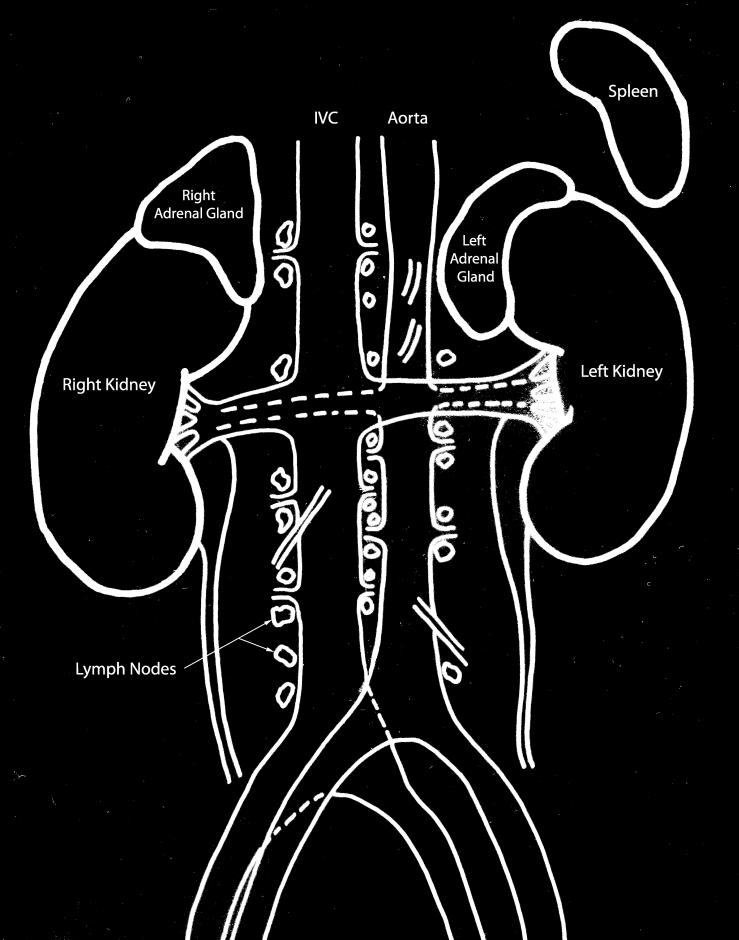 Department of surgery Retroperitoneal lymph node dissection (RPLND) This information describes the operation to remove the residual lymph nodes at the back of the abdomen as part of your treatment