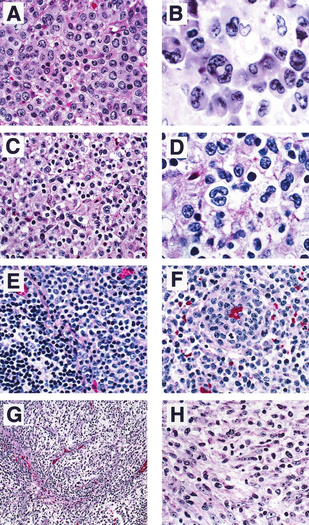 FIGURE 2. Histologic spectrum of ALCL. A, Cells are large with abundant amphophilic cytoplasm and distinct cytoplasmic borders. A cohesive growth pattern is present.