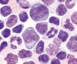 Onciu et al / ANAPLASTIC LARGE CELL LYMPHOMA WITH LEUKEMIC MANIFESTATION A B C der(5) der(2) and CD25 (dim) and HLA-DR. They were negative for all remaining markers tested.